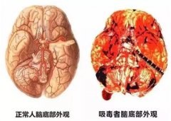 毒瘾多久发作一次?怎样才能有效的戒断毒品?